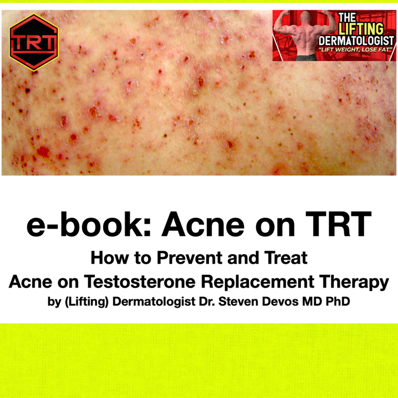 e-book Acne on TRT